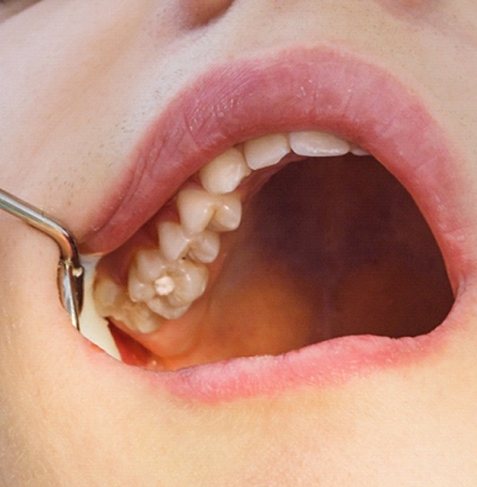 An up-close look at a child’s upper teeth and a dental mirror holding the lip and cheek for adequate exposure