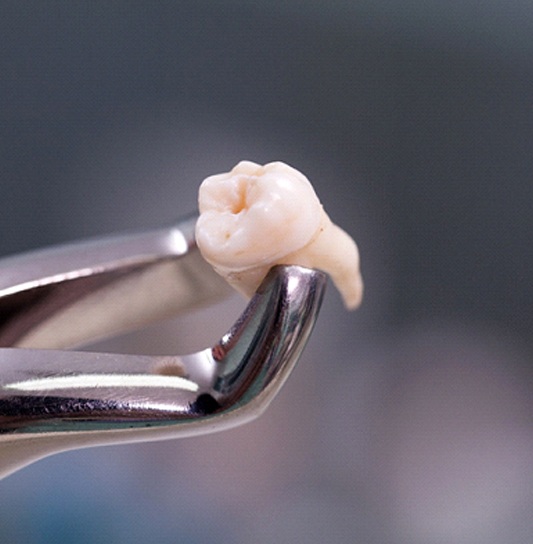 An up-close image of a dental instrument holding an extracted tooth