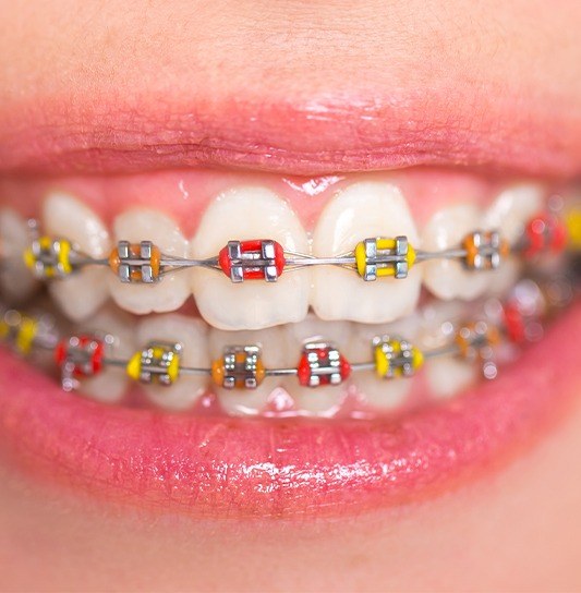 Closeup of smile with braces