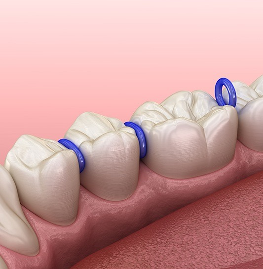 Animted smile with space maintainers in place