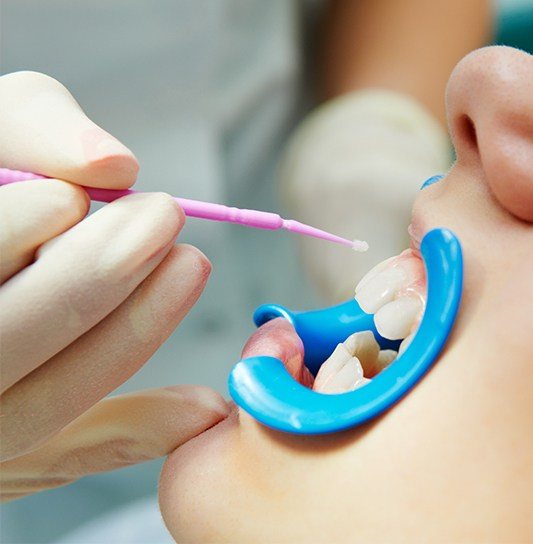 Child receiving fluoride treatment