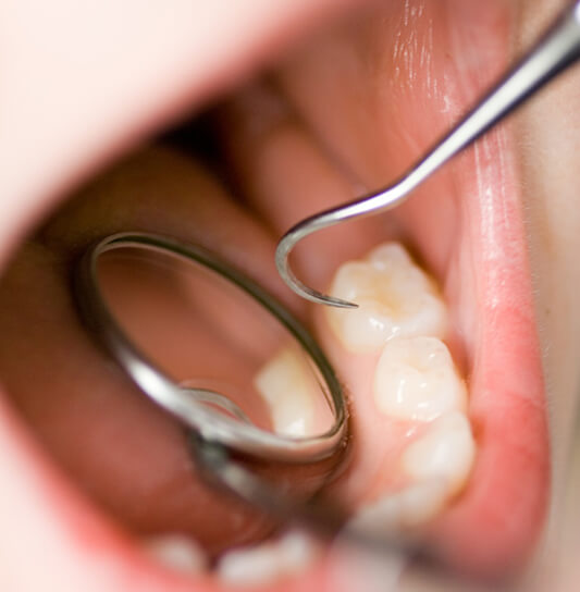 A dentist examining a child’s back molars 